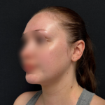 Neck liposuction Before & After Patient #2411
