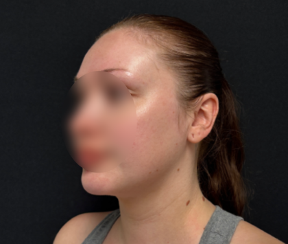 Neck liposuction Before & After Patient #2411