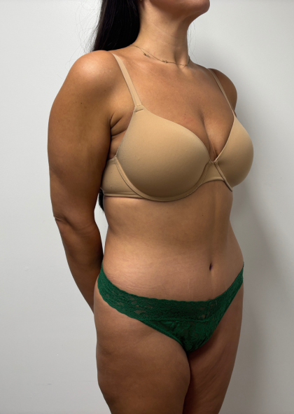 Abdominoplasty Before & After Patient #2408