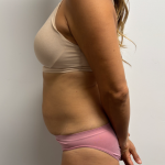 Abdominoplasty Before & After Patient #2409