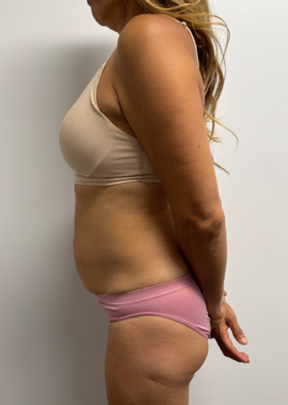 Abdominoplasty Before & After Patient #2409
