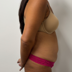 Abdominoplasty Before & After Patient #2408
