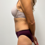 Abdominoplasty Before & After Patient #2409