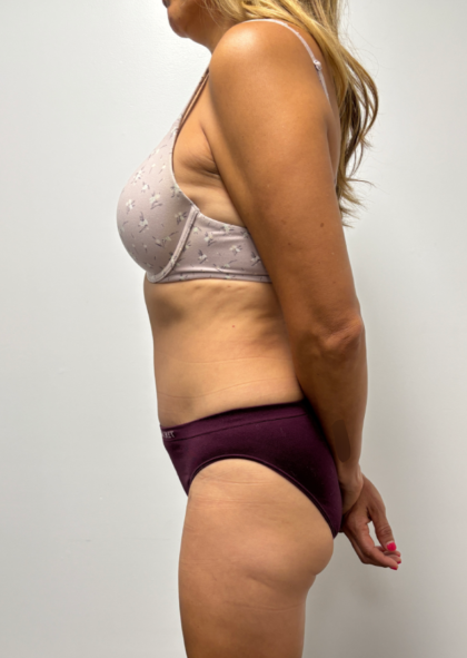 Abdominoplasty Before & After Patient #2409