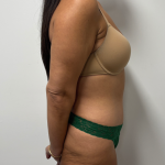 Abdominoplasty Before & After Patient #2408