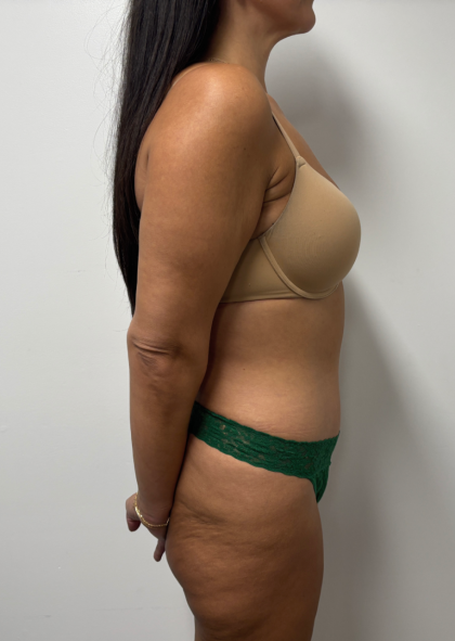 Abdominoplasty Before & After Patient #2408