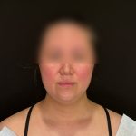 Chin Liposuction Before & After Patient #2523