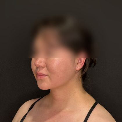 Chin Liposuction Before & After Patient #2523