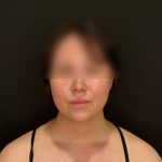 Chin Liposuction Before & After Patient #2523