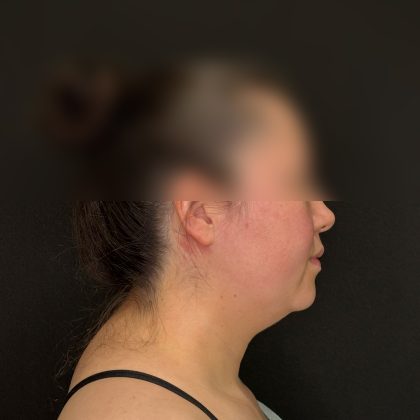 Chin Liposuction Before & After Patient #2523