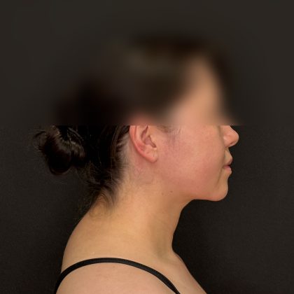 Chin Liposuction Before & After Patient #2523