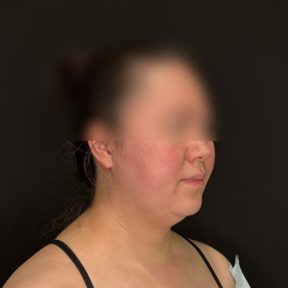Chin Liposuction Before & After Patient #2523