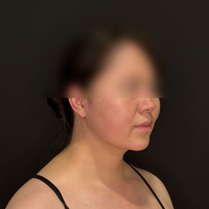 Chin Liposuction Before & After Patient #2523