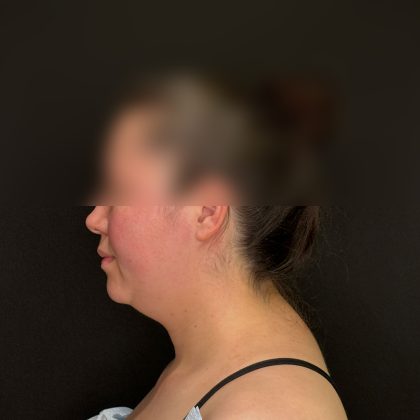 Chin Liposuction Before & After Patient #2523