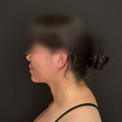 Chin Liposuction Before & After Patient #2523