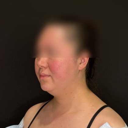 Chin Liposuction Before & After Patient #2523