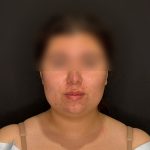 Chin Liposuction Before & After Patient #2524