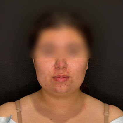 Chin Liposuction Before & After Patient #2524