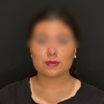 Chin Liposuction Before & After Patient #2524
