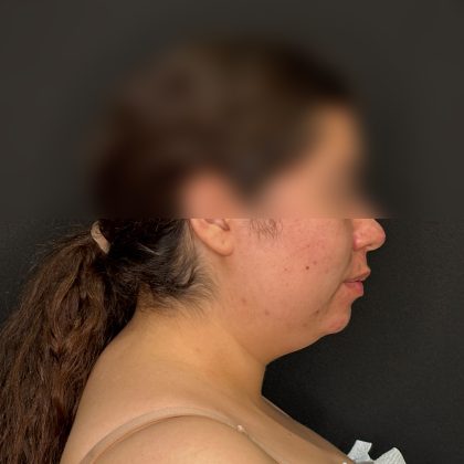 Chin Liposuction Before & After Patient #2524