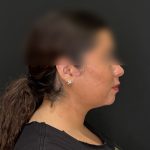 Chin Liposuction Before & After Patient #2524