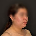 Chin Liposuction Before & After Patient #2524
