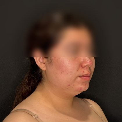 Chin Liposuction Before & After Patient #2524