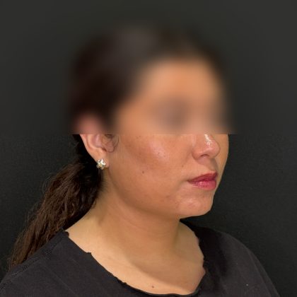 Chin Liposuction Before & After Patient #2524