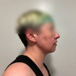 Chin Liposuction Before & After Patient #2525