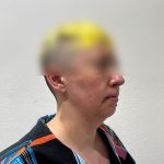 Chin Liposuction Before & After Patient #2525