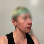 Chin Liposuction Before & After Patient #2525