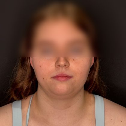Chin Liposuction Before & After Patient #2526