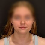 Chin Liposuction Before & After Patient #2526