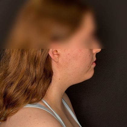 Chin Liposuction Before & After Patient #2526