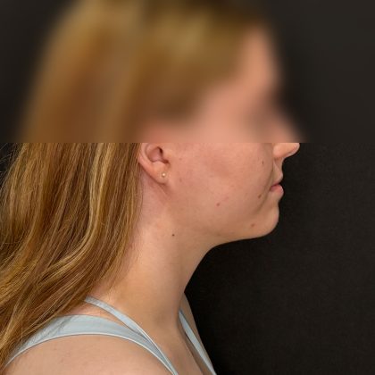 Chin Liposuction Before & After Patient #2526
