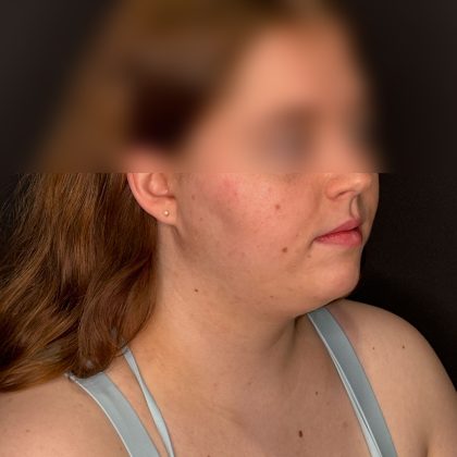 Chin Liposuction Before & After Patient #2526