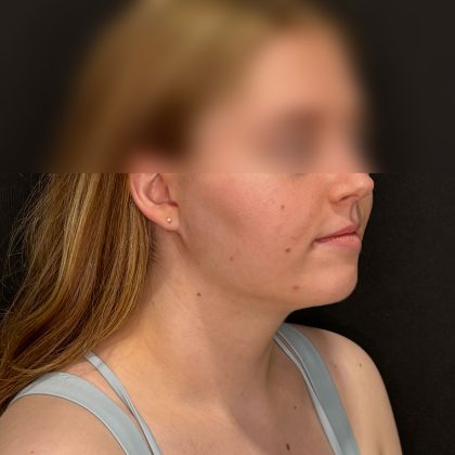 Chin Liposuction Before & After Patient #2526